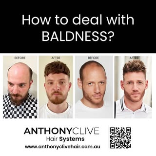 The other alternative to hair transplants. Anthony Clive hair systems are affordable, quick and most