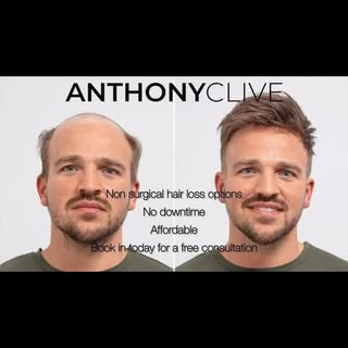 Anthony Clive is a non surgical option for male baldness and hair loss. With no down time and afford