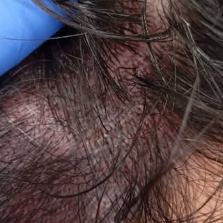 🔹 ¿Sientes que tu cabello ha perdido densidad en la línea frontal o las sienes? 
🔹 ¿Te gustaría un