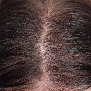 ✨ Micropigmentación capilar efecto densidad para mujer
¿Notas que tu cabello ha perdido volumen y tr