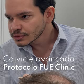 Este paciente realizou transplante capilar após uma avaliação criteriosa e um planejamento individua