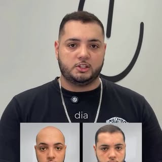 O Davi chegou com uma calvície avançada já com 25 anos, preparamos a área doadora, a área calva e fi