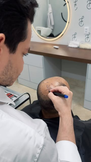 Calvície extensa também tem solução, acompanhe o caso do dia!