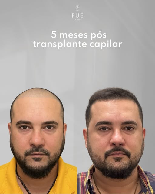 Uma calvície avançada de um lado e um novo homem, com a sua autoestima de volta e cabeludo do outro.