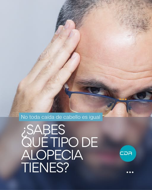 ¿Perder entre 50 y 100 cabellos al día es normal?
Sí lo es, pero cuando notas áreas despobladas, men