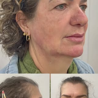 Neste vídeo, mostro o resultado de um tratamento global de rejuvenescimento facial. Melhoramos o big