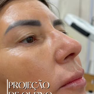 O poder do preenchimento de mento! 

✨Muitas vezes, a falta de projeção no queixo tira a harmonia de