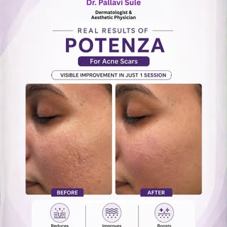 ✨ POTENZA MNRF | Advanced Acne Scar Treatment

Acne scars are more than a surface concern—they requi