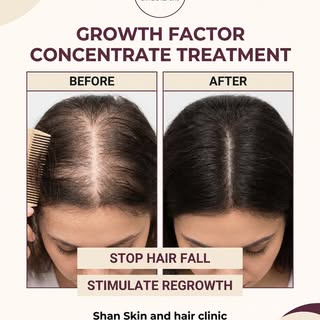 Shan skin and hair clinic 
GFC treatment for hairloss

#gfc #hairloss #hairfalltreatment