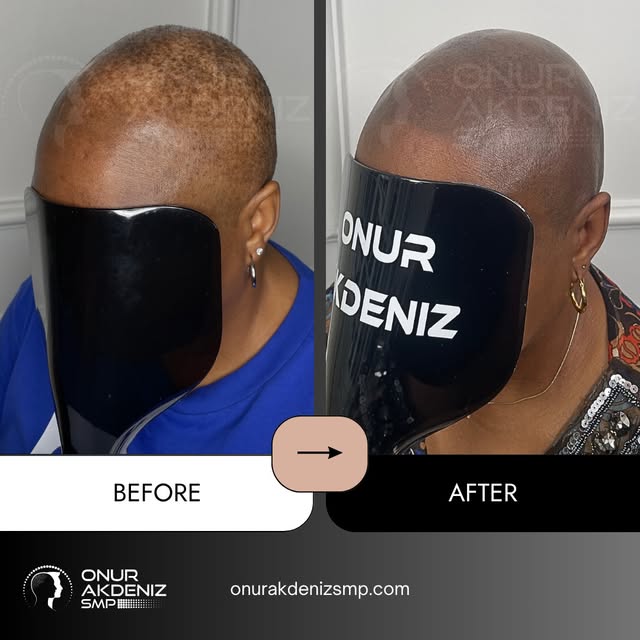 Flawless Density & Natural Camouflage for Female Scalp Micropigmentation

Scalp Micropigmentation is