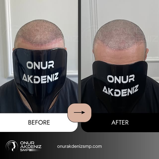 Bridging the Density Gap After a Hair Transplant

A hair transplant can recreate your hairline, but 