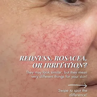 They may look alike but your skin needs very different care depending on the cause!

Here’s how to t