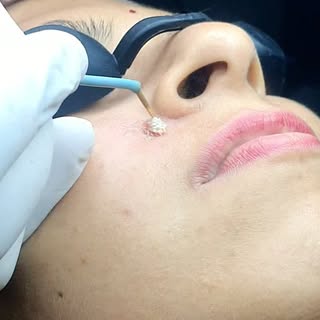 Safe, effective wart removal for smoother, clearer skin because confidence starts with healthy skin.