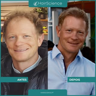 Na HairScience, acreditamos que o transplante capilar vai muito além da aparência. É um passo import