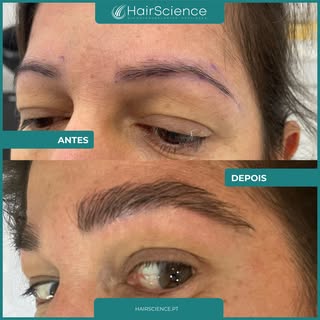 Na HairScience, cada detalhe conta. Este é o resultado de um transplante de sobrancelhas cuidadosame