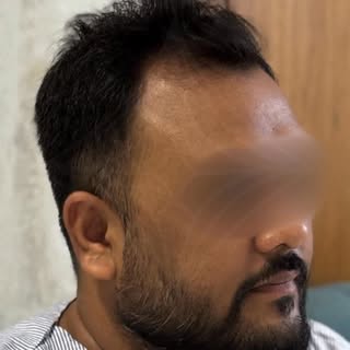 New hair. New confidence. New beginning.

Book your hair transplant at Bellisima Clinic today!
+91 8