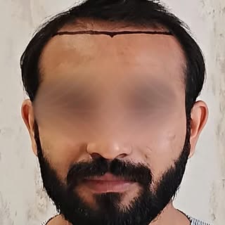 One decision. One transformation.
Natural hair. Natural confidence.

Book your hair transplant at Be