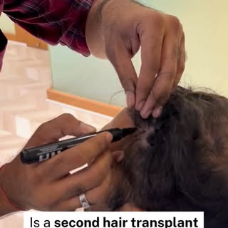 A failed hair transplant is not the end of the journey.

A few months ago, a patient from the USA vi