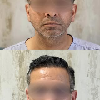 A successful hair transplant isn’t just about growing hair—it’s about restoring self-confidence and 