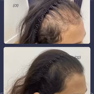9 rounds of PRP, nutrafol, topical prescriptions… and STILL losing hair?! 😳
Here’s how we actually 
