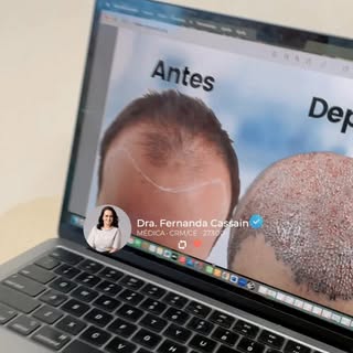 Transplante capilar NÃO é a primeira opção na alopecia androgenética 
Vem entender porque