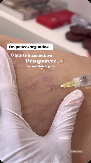 Diga adeus aos vasinhos e olá à confiança nas suas pernas! #tokdebelezaoficial #autoestima #transfor