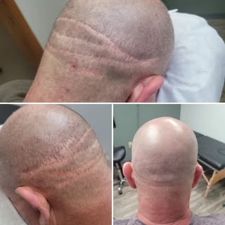 Old transplant scars vs todays session. Still some work to do, but we are proceeding nicely!

 #lose