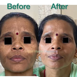 Facial pigmentation can be due to various reasons .
First step to curb is to start using a medicated