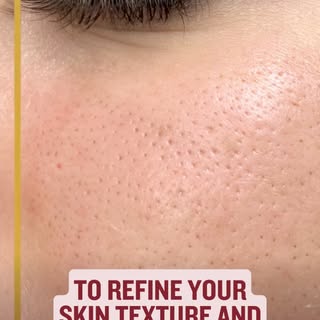Tired of visible open pores? 😩✨

Large pores can make your skin look uneven and dull. Excess oil, d