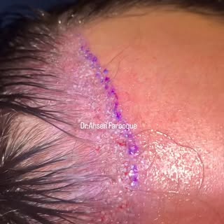 #hairtransplant #dhi #dhidubai #dhihairtransplantdubai #besthair