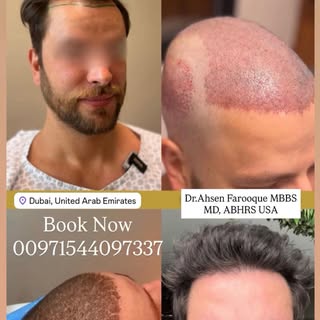 Direct Hair Implantation (DHI) is an advanced, minimally invasive hair restoration technique that en