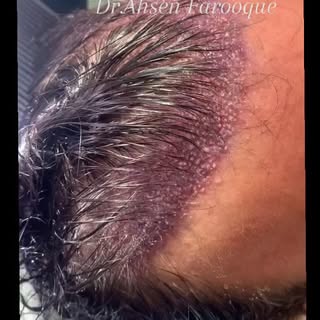 #HairTransplantDubai
#DubaiHairTransplant
#HairTransplant
#HairRestoration
#HairLoss