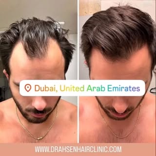 #dhihairtransplant #hairtransplantdubai #dhidubai #fuehairtransplant #hairtransplant