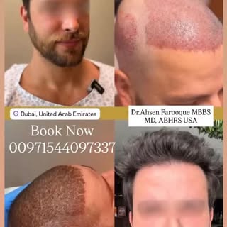 #dhihairtransplant #HairTransplant
#HairTransplantDubai
#DubaiHairTransplant
#HairRestoration
HairRe