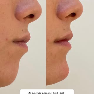 Mentoplastica liquida by Dr. Michele Cardone 
La bellezza si vede nei dettagli ✨