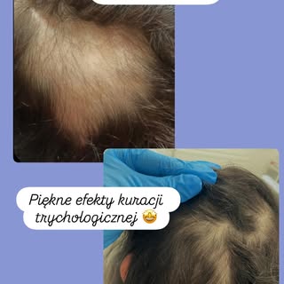 Efekty kuracji trychologicznej po leczeniu onkologicznym ( naświetlanie ) 
Piękny odrost włosów i du