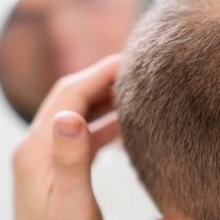 Frontal balding to a full, natural-looking hairline. The before and after speaks for itself. 👏

#ha