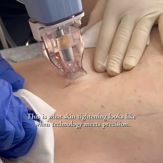 Unlike traditional treatments, Ellacor removes tiny micro-cores of skin to improve wrinkles and skin