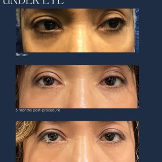 Swipe to see Dr. Gharbi’s transformations using AGNES radiofrequency technology for upper and lower 