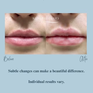 Drs. Nael and Shazel Gharbi take a personalized approach to lip filler, focusing on balance, symmetr
