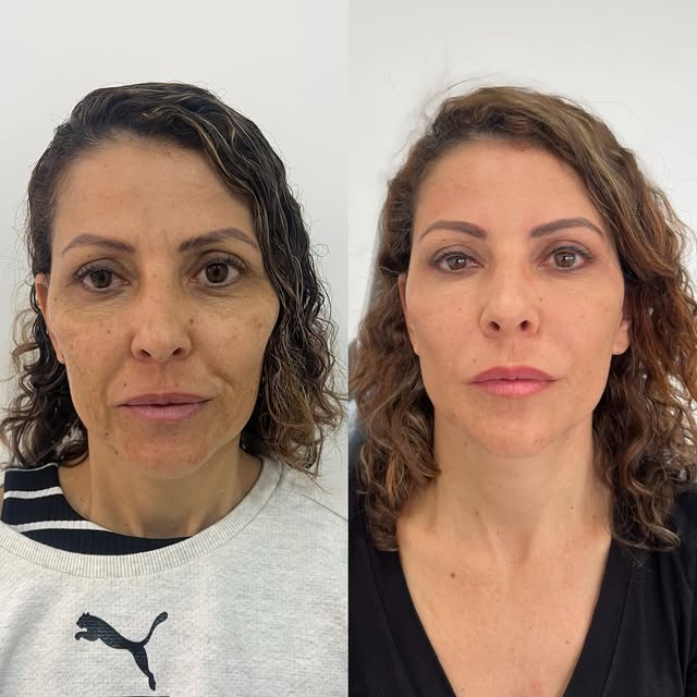 Embelezamento natural é alcançar resultados estratégicos que minimizam sombras no rosto do paciente,
