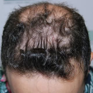 קבלו את דודי היקר
רק 6 חודשים אחרי ההשתלה וכבר אפשר לראות את הצמיחה הראשונית.
מבטחים לעדכן בהמשך כשנ