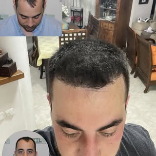 לפני כשנה ערן החליט לעשות שינוי ולהחזיר לעצמו את המראה שתמיד רצה. היום, אחרי השתלת שיער בשיטת DHI ות