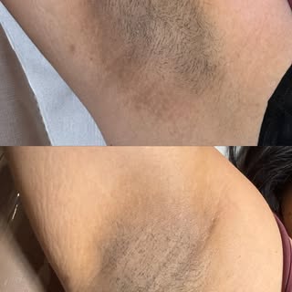 Axilas escurecidas também têm tratamento!

Se essa região te incomoda, ou se você tem alguma outra á