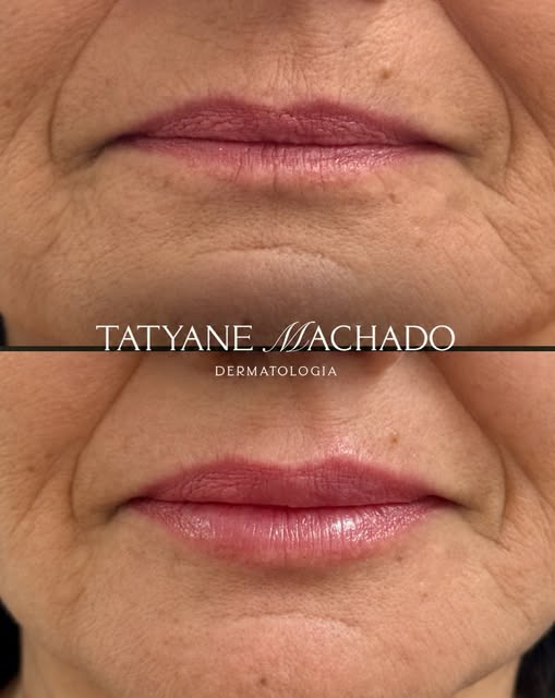 O melhor preenchimento labial é aquele que chama atenção pela beleza, não pelo exagero! 

Agende seu