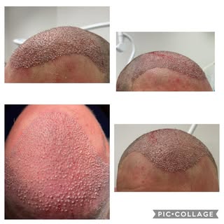 Rehacemos primera linea - entradas y rellenamos frontal - zona media en un paciente de 27 años!

#dr