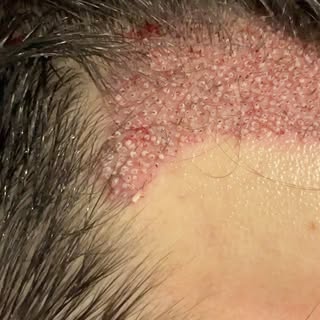 Rehacemos el frontal, buscando siempre la naturalidad y con muchísima densidad gracias a una zona d