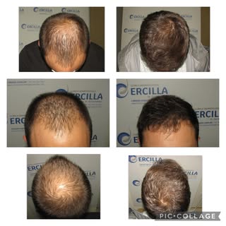 En este collage podemos ver la evolución de nuestro paciente. Han pasado 7 meses desde la cirugía, a