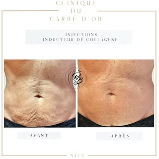 ✨ Retrouvez une peau plus ferme et plus lisse grâce aux injections d’inducteur de collagène ✨

Après