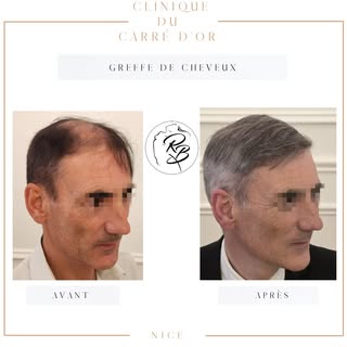 ✨ Redonnez vie à votre image avec une greffe capillaire haut de gamme.
Notre clinique esthétique met